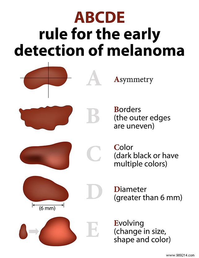 Skin cancer:how to check your moles? 