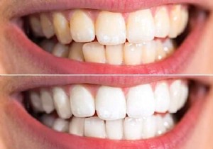 Whiten Your Teeth Fast With This 100% Natural Tip. 