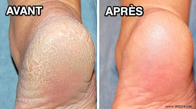 Damaged feet? 3 Remedies for Dry, Swollen and Cracked Feet. 