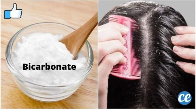 Baking Soda:The Miracle Tip Against Dandruff. 