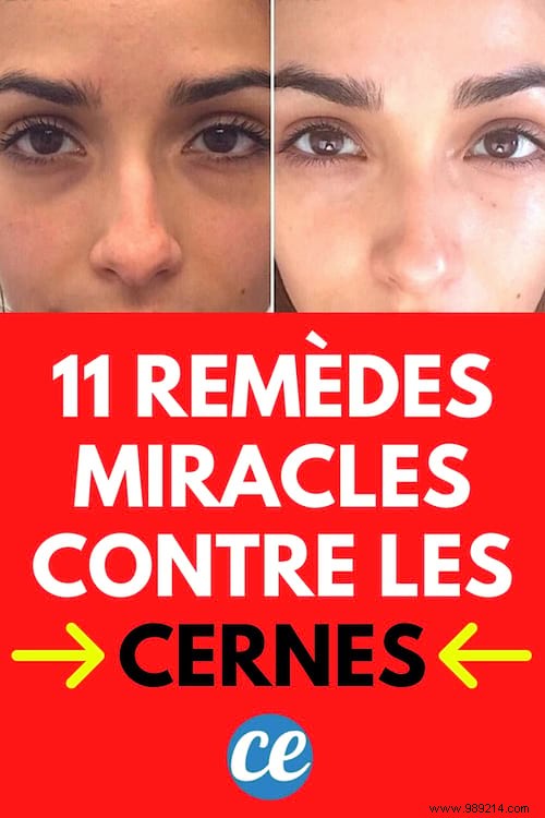 11 Grandma s Remedies To Eliminate Dark Circles Fast. 