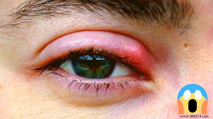 Styes:The 12 Best Remedies To Get Rid Of Them Very Quickly. 