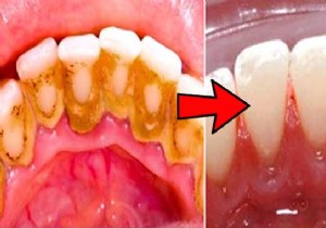 3 Amazing Tips To Remove Dental Tartar By Yourself. 