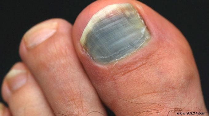 How to Make a Black Toenail Disappear. 