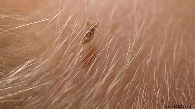 4 Teacher Tips for Fighting Lice. 