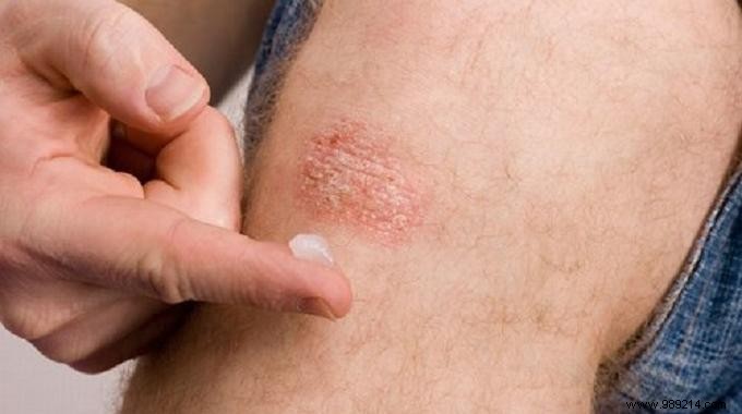 The 7 Effective and Natural Remedies to Relieve Psoriasis. 