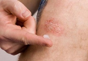 The 7 Effective and Natural Remedies to Relieve Psoriasis. 