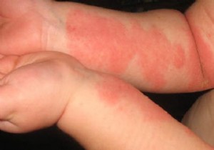 My Little Tips To Relieve Eczema. 