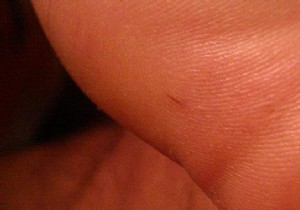 How to Remove a Splinter in the Foot, Finger or Hand? 