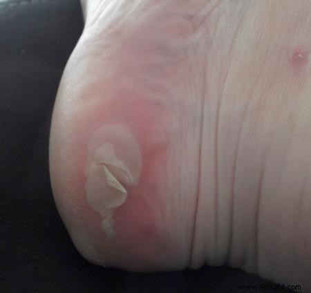 Small Effective Remedies to Cure Blisters Naturally. 