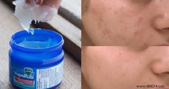 18 Magical Uses of VapoRub Everyone Should Know. 