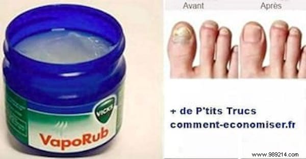 18 Magical Uses of VapoRub Everyone Should Know. 