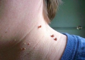 Skin Tags:How to Make Them Disappear with Apple Cider Vinegar. 