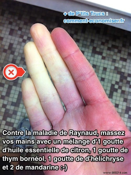 Raynaud s Disease:The Really Effective Remedy To Stop Suffering From It! 