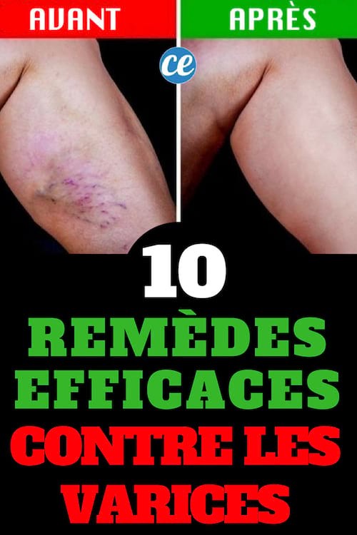 10 Miracle Remedies To Make Varicose Veins Disappear Naturally. 