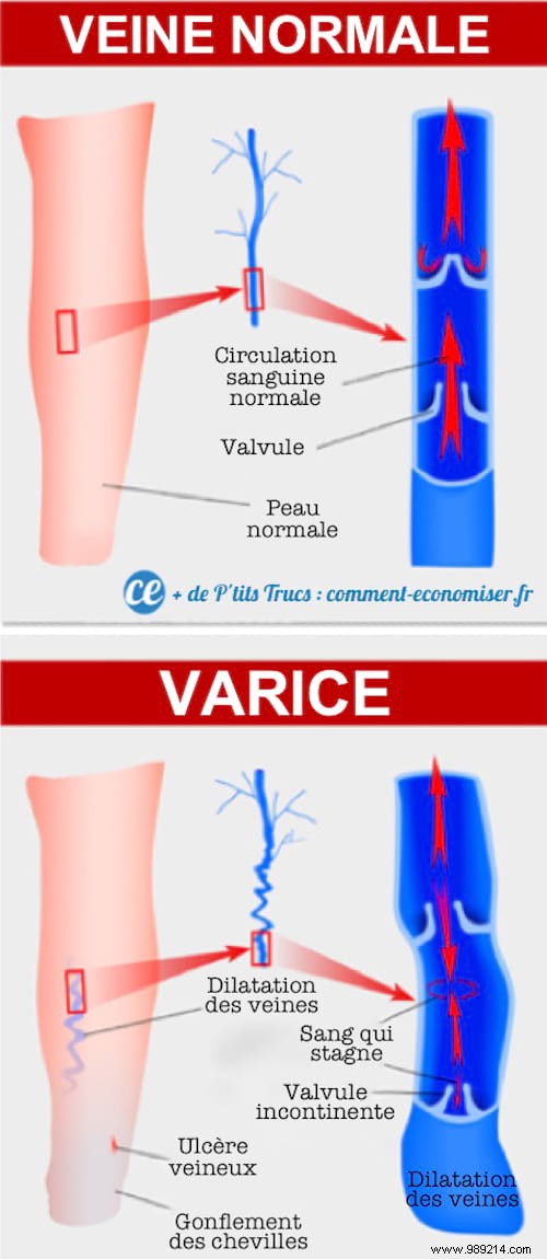 10 Miracle Remedies To Make Varicose Veins Disappear Naturally. 