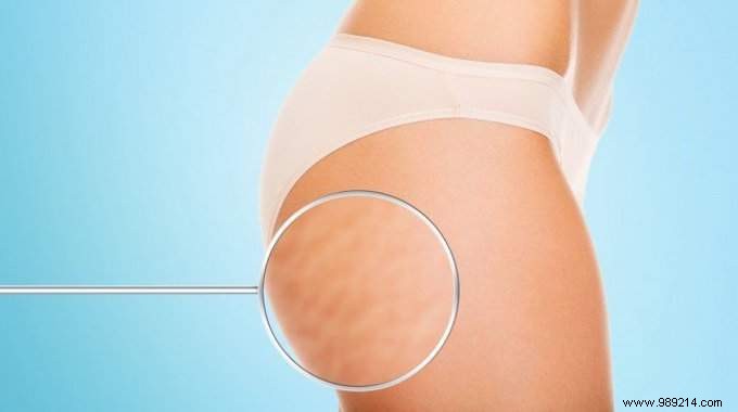 6 Easy Exercises To Lose Cellulite In Just 2 Weeks. 