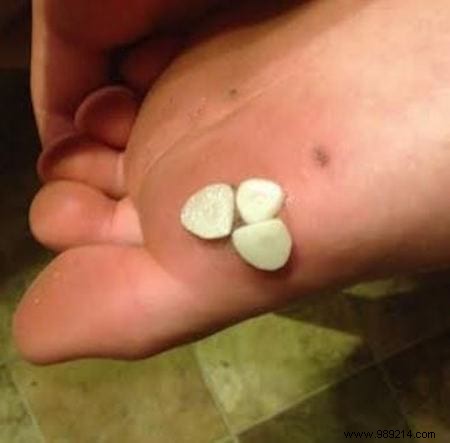 The Ancestral Remedy To Remove A Wart With Garlic (Quickly!). 