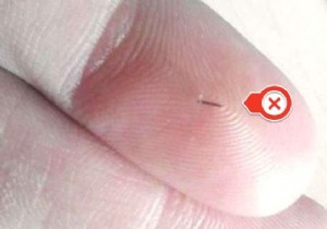 How to Remove a Sunken Finger Thorn EASILY. 