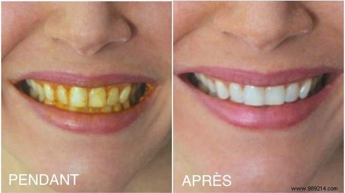 How To Whiten Yellow Teeth With Turmeric (100% Natural And Effective). 