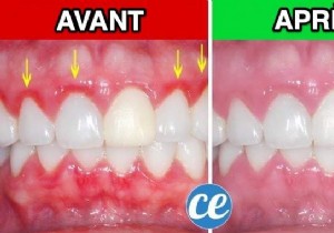 Gingivitis:The Natural And Effective Remedy To Quickly Calm Pain. 