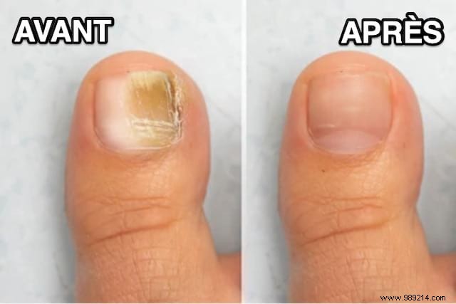 Nail Mycosis:The Miracle Remedy To Get Rid Of It Easily. 