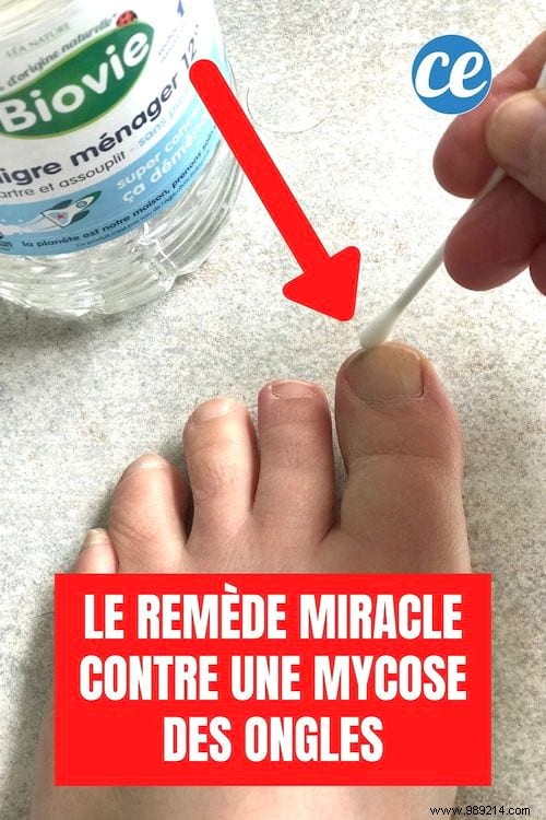 Nail Mycosis:The Miracle Remedy To Get Rid Of It Easily. 