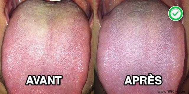 Oral Thrush:The Tried And Approved Remedy To Get Rid Of It Fast. 