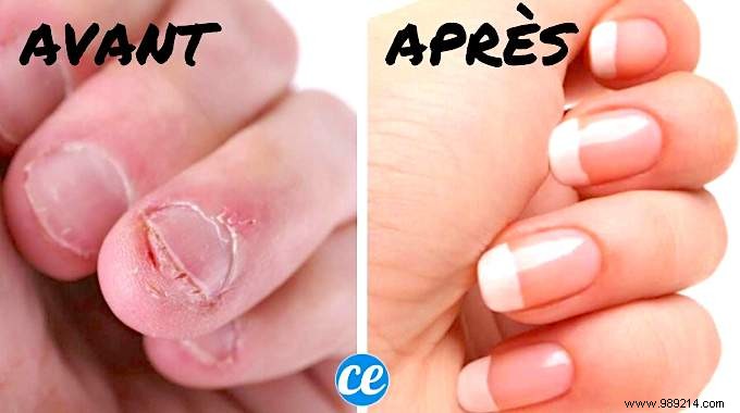 6 Tips That Work To Never Bite Your Nails Again. 