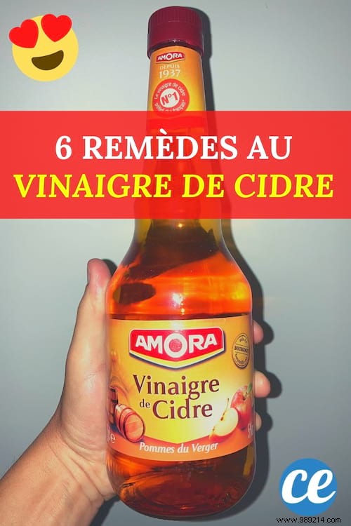 6 Apple Cider Vinegar Remedies To Cure Your Little Boos. 