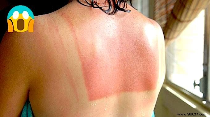 Sunburn:The Magic Bicarbonate Remedy! 