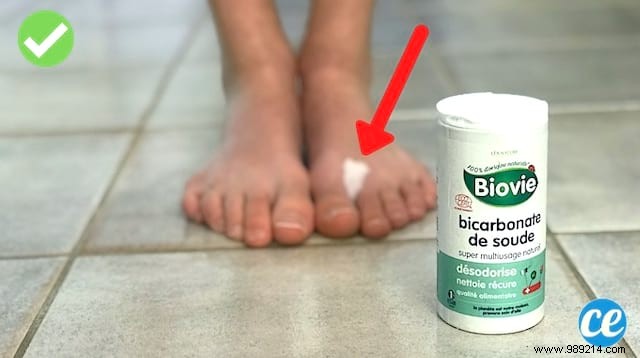 How To Cure Mycosis Naturally With Bicarbonate? 