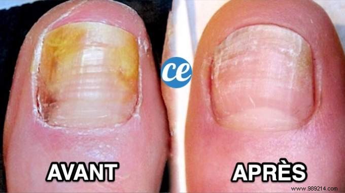 Nail Fungus:My 5 Natural Remedies To Get Rid Of It. 