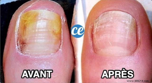 Nail Fungus:My 5 Natural Remedies To Get Rid Of It. 