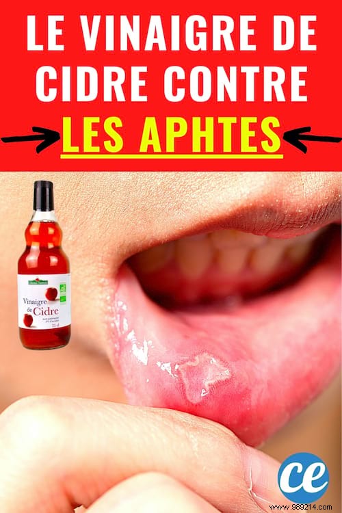 2 Cider Vinegar Remedies for Canker Sores and Gingivitis. 