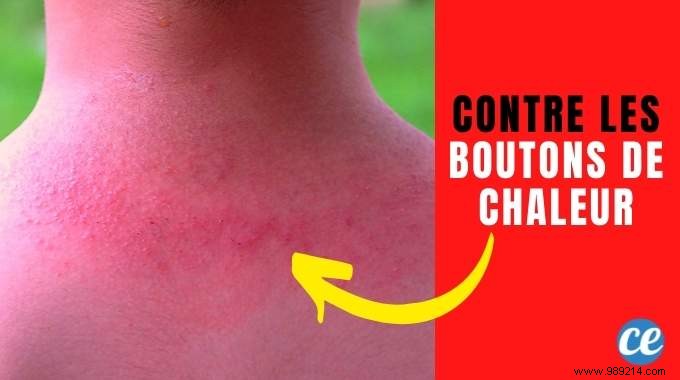 8 remedies that work to get rid of heat rash. 