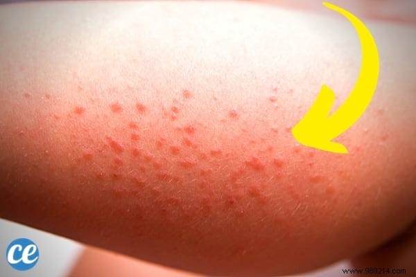 8 remedies that work to get rid of heat rash. 