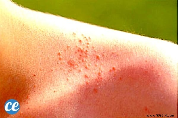 8 remedies that work to get rid of heat rash. 