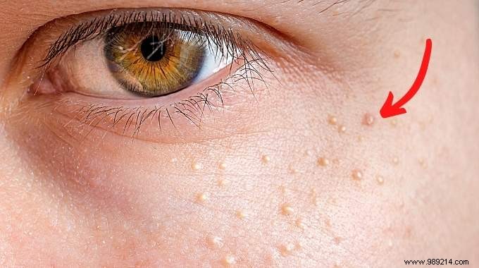 How to Remove Milium Grains Under the Eyes? 16 Natural Treatments. 