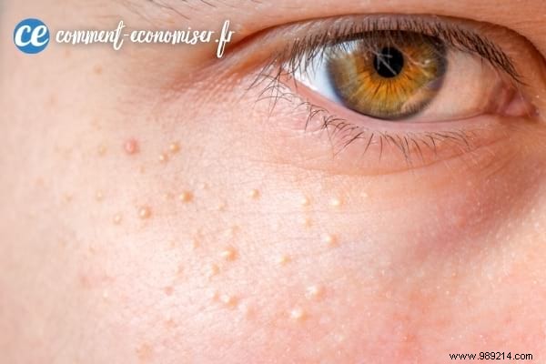 How to Remove Milium Grains Under the Eyes? 16 Natural Treatments. 