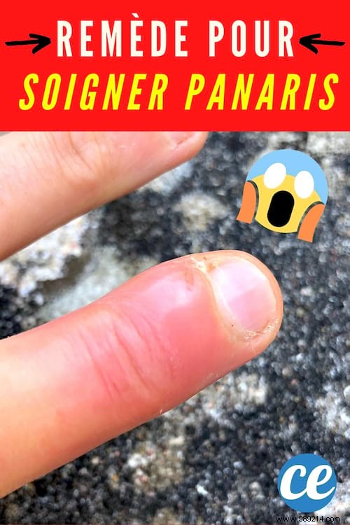 How to Treat a Paronychia on the Finger? The Express Remedy in 48 hours. 