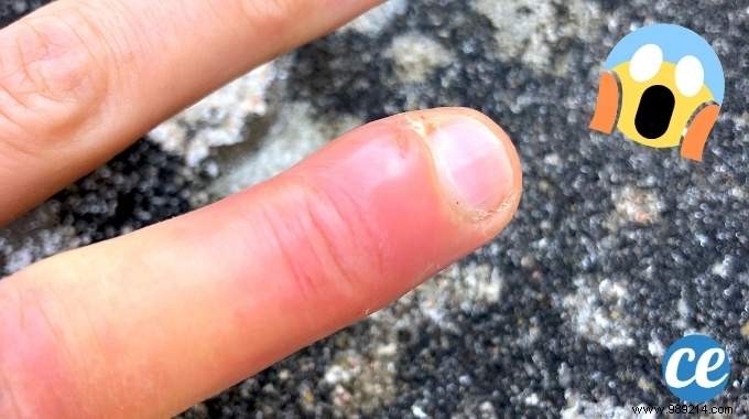 How to Treat a Paronychia on the Finger? The Express Remedy in 48 hours. 