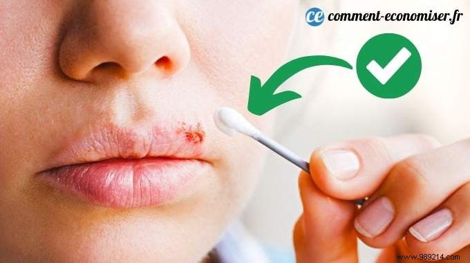 11 Grandma s Remedies To Cure A Cold Sore As Fast As Possible. 