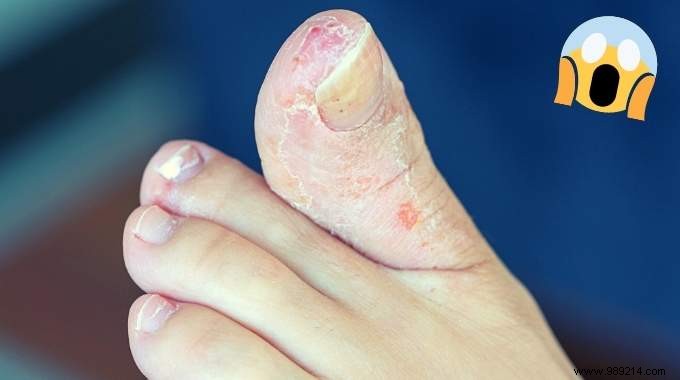 Athlete s Foot:The Quick and Natural Treatment to Get Rid of It. 