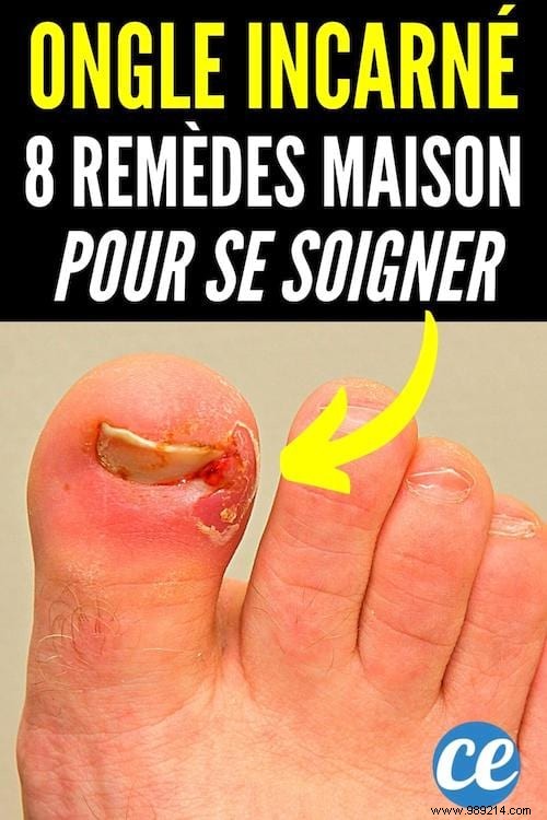 Ingrown Toenail:8 Quick and Effective Remedies to Get Rid of It. 