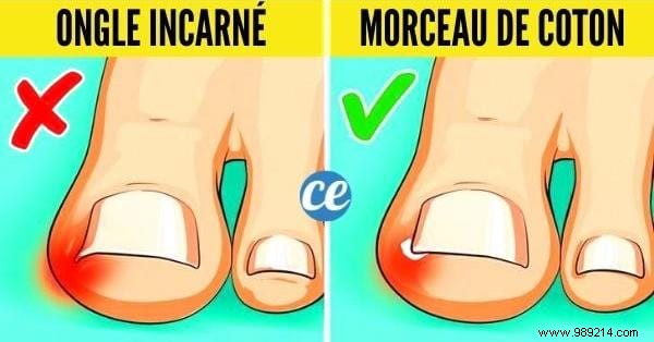 Ingrown Toenail:8 Quick and Effective Remedies to Get Rid of It. 