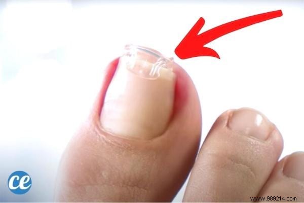 Ingrown Toenail:8 Quick and Effective Remedies to Get Rid of It. 