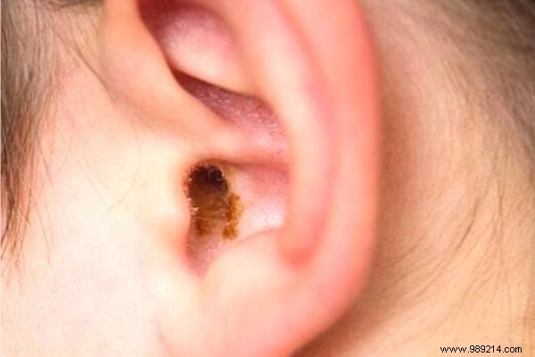 Forget Cotton Swabs! Here s How To Safely Clean Your Ears. 