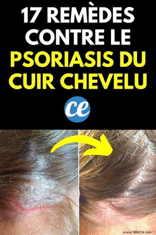 17 Remedies for Scalp Psoriasis (Revealed by a Dermatologist). 