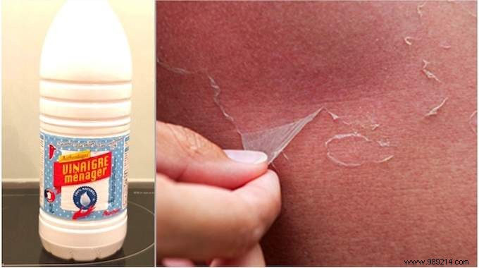 Sunburn:Use White Vinegar To Not Peel (And Avoid Blisters). 